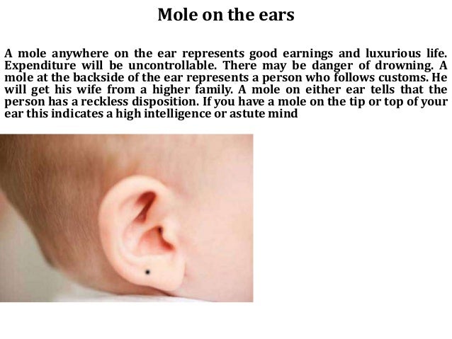On Of Side Mole Forehead Left On Of Side Mole Forehead Left